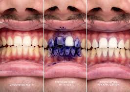 Hismile v34 Colour Corrector, Tooth Stain Removal, Teeth Whitening Booster
