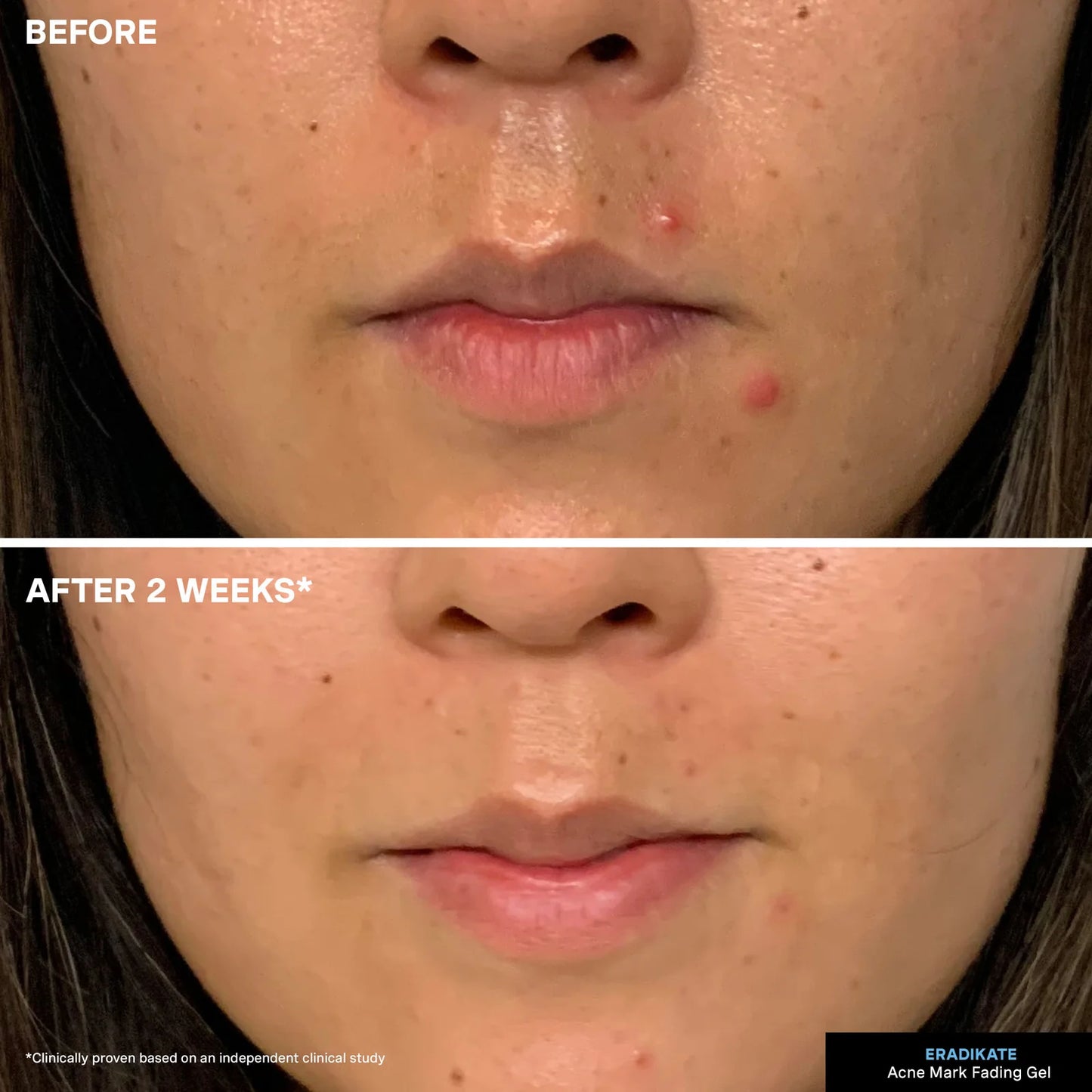 EradiKate Acne Mark Fading Gel