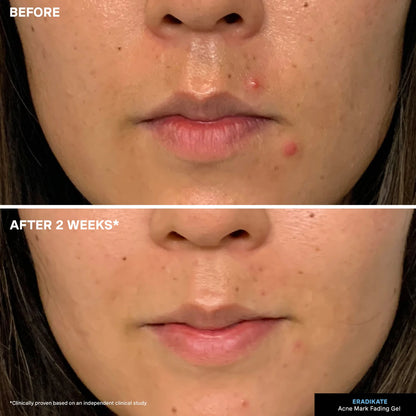EradiKate Acne Mark Fading Gel